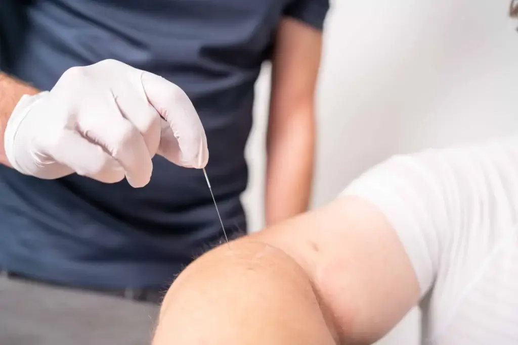 dry needling fysiotherapie